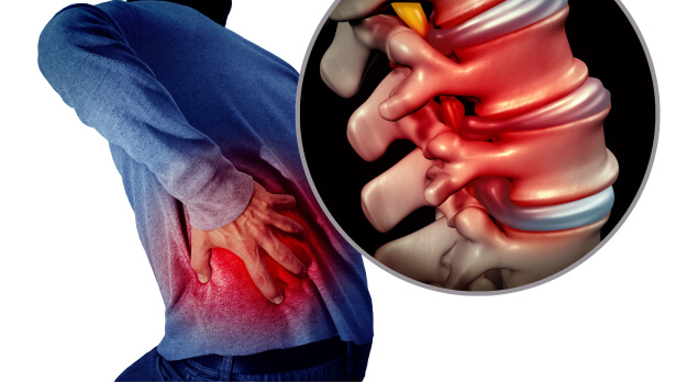 Bulging Discs Symptoms Causes And Treatments The Nerve Disc Institute