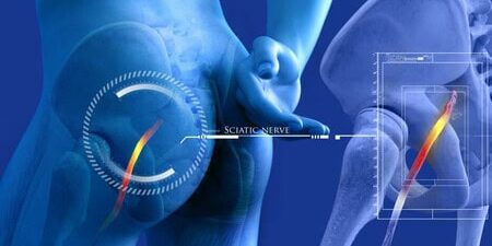 Illustration of herniated disc affecting the sciatic nerve in the lower back.