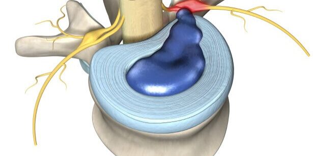 Detailed illustration of a herniated disc compressing spinal nerves.