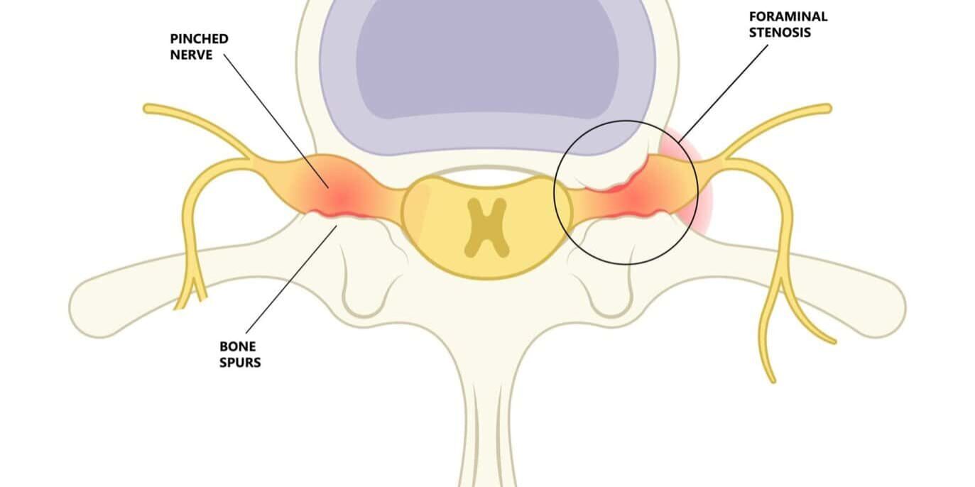 Illustration of foraminal stenosis affecting spinal nerves and discs.