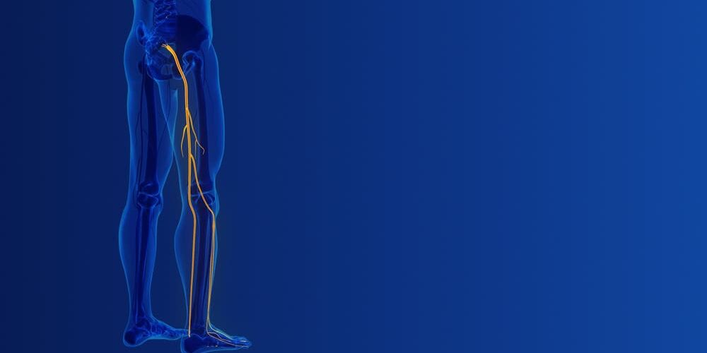 Illustration of sciatic nerve pain and disc issues in the lower back and leg.