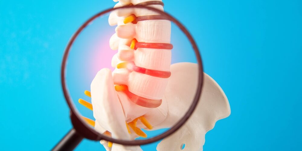 Model of lumbar spine with nerve compression, highlighting sciatic pain.