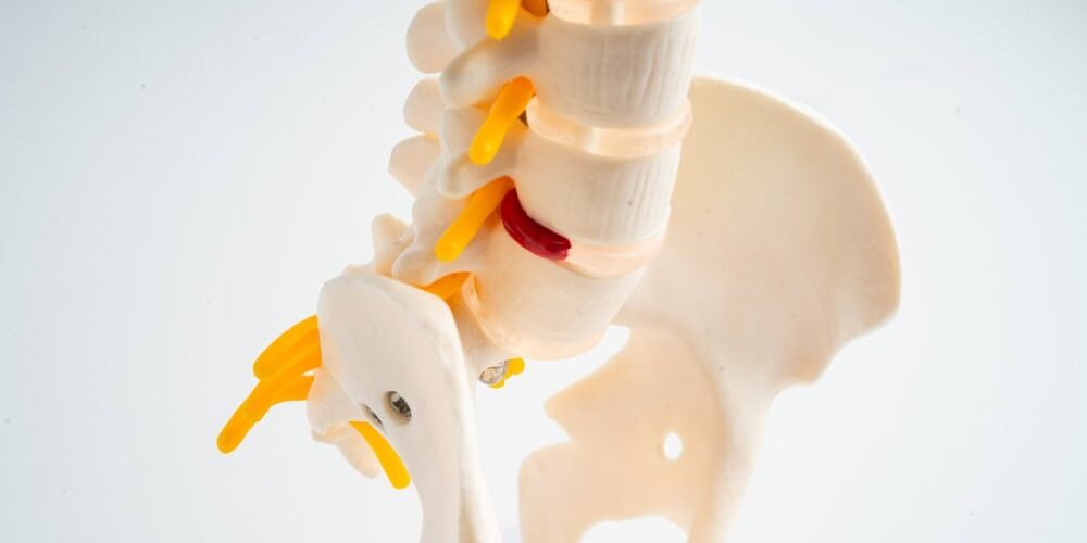 Spinal nerve and disc model for herniated disc relief and natural healing.